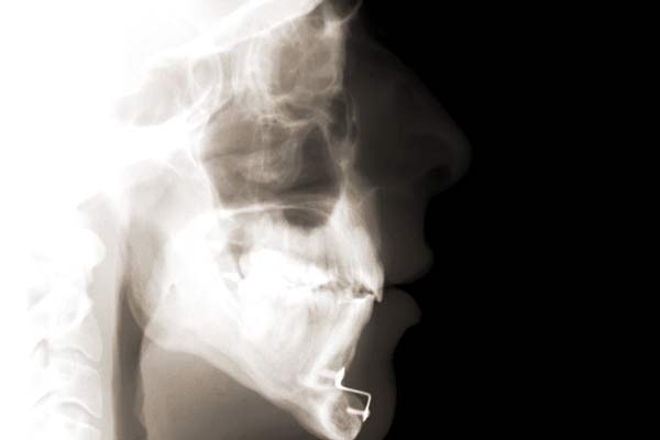 Fernröntgenseitenbild (FRS)